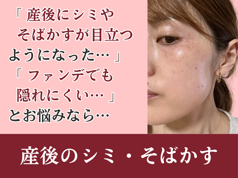 産後のシミ・そばかす