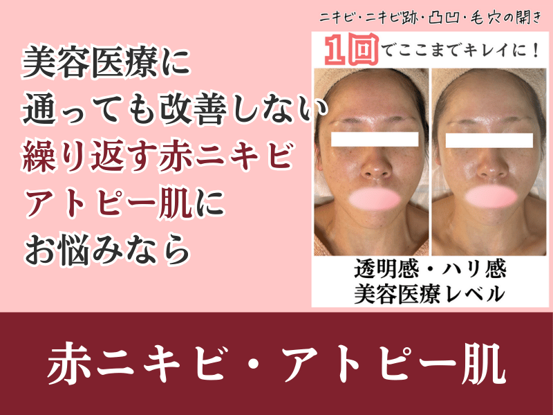赤ニキビ・アトピー肌