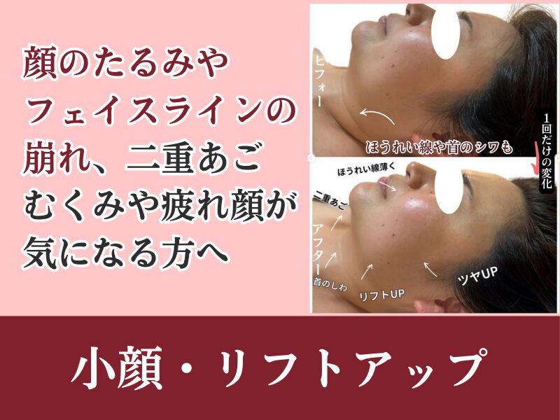 小顔・リフトアップ