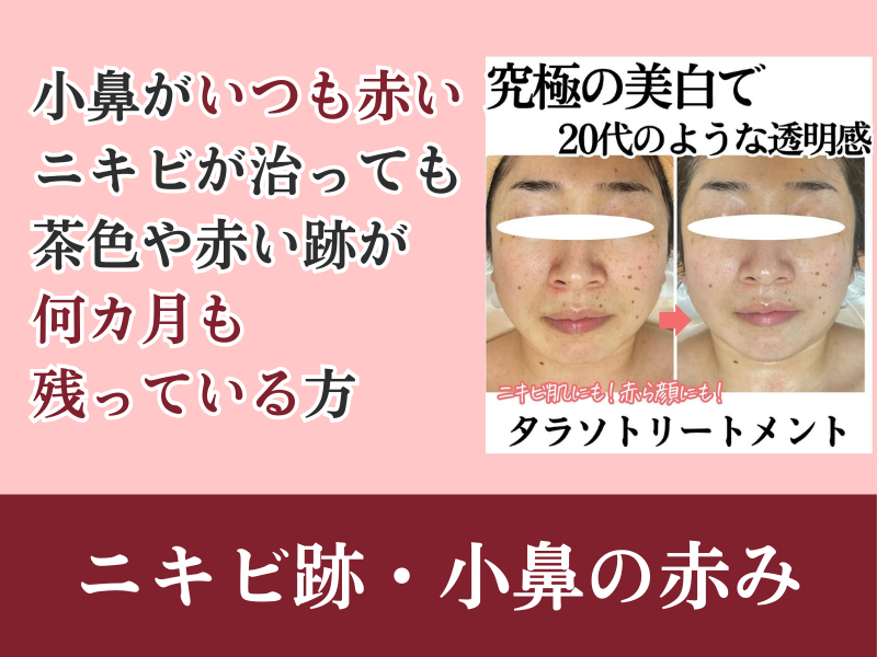 ニキビ跡・小鼻の赤み