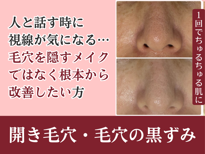 開き毛穴・毛穴の黒ずみ