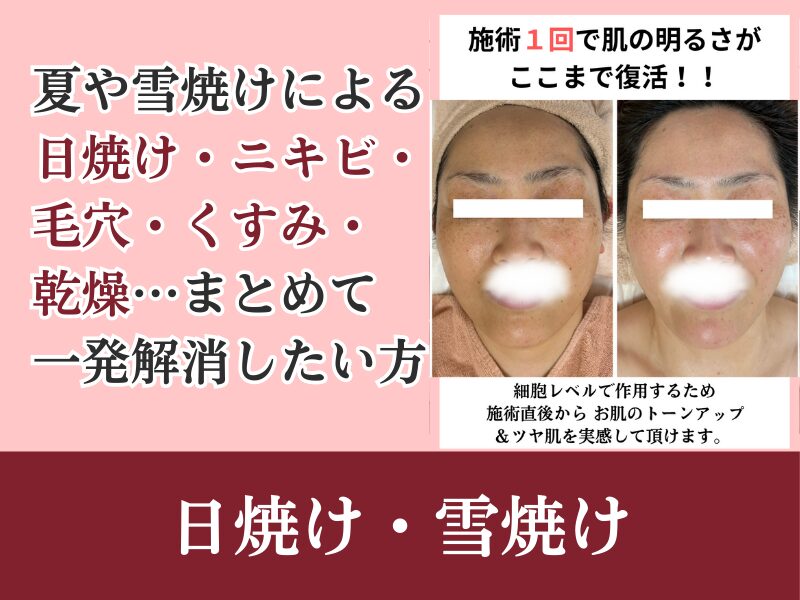 日焼け・雪焼け